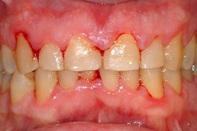  Bị chảy máu chân răng khi đánh răng, tình trạng khiến nhiều người hoang mang